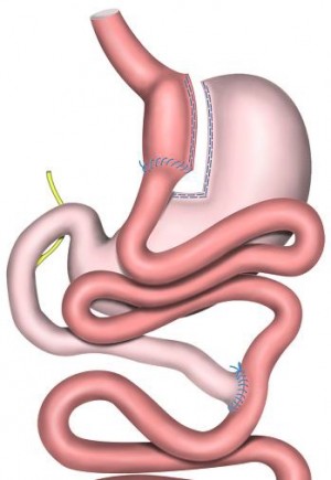 위 절재 수술은 위암 치료에도 쓰이지만 음식물 섭취를 제한해 고도비만을 치료할 때도 쓰인다. 사진은 고도비만 치료에 쓰이는 위 절제술. - 동아사이언스 자료사진 제공